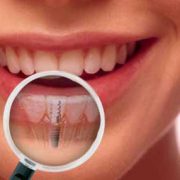 implante-dental-clinica-dental-pilar-rico