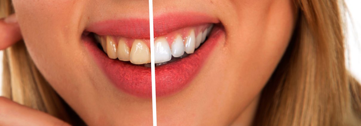 cuidar tu boca con tratamiento de blanqueamiento dental