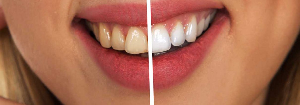 limpieza-dental-la-solucion-para-una-sonrisa-sana-y-estetica