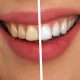 limpieza-dental-la-solucion-para-una-sonrisa-sana-y-estetica